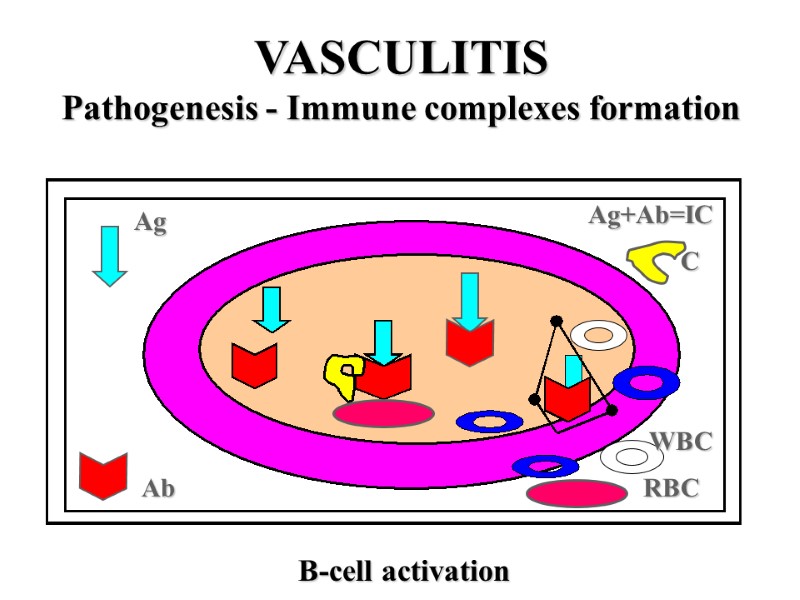 VASCULITIS Pathogenesis - Immune complexes formation Ag Ab WBC Ag+Ab=IC C B-cell activation 